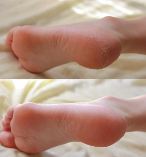 Pedicure.,Cracks,And,Dry,Callus,On,The,Heels.,Sloppy,And