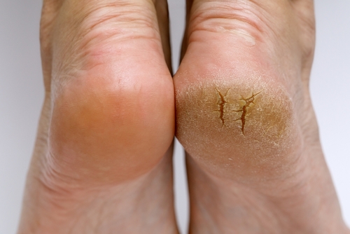 Cracked,Heels,Before,And,After,Treatment,And,Treatment.,Medical,Pedicure