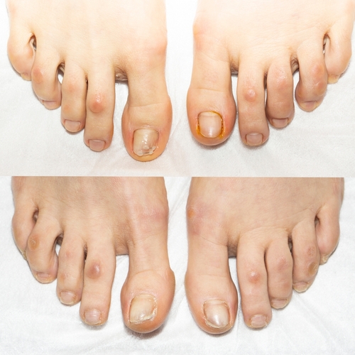 Collage.,Toes,Before,And,After,The,Pedicure,Procedure,With,The