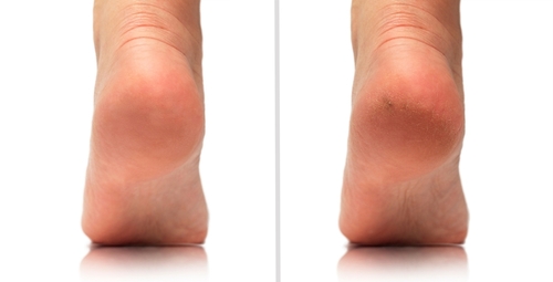 Image,Before,And,After,Feet,Dry,Skin,Cracked,Heel,Treatment.